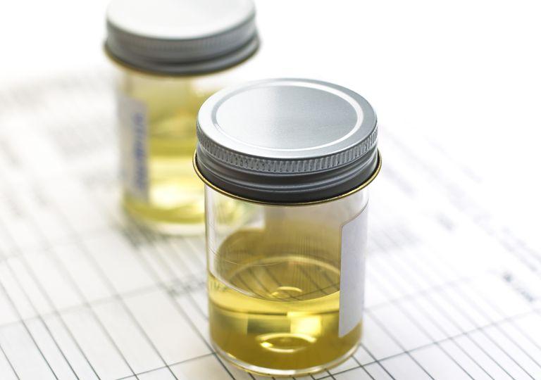 Research Shows Urine Test Could Detect Womb Cancer