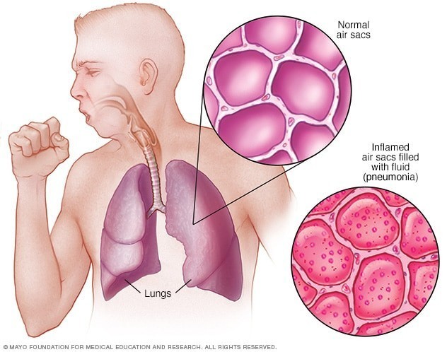 How to prevent pneumonia for babies