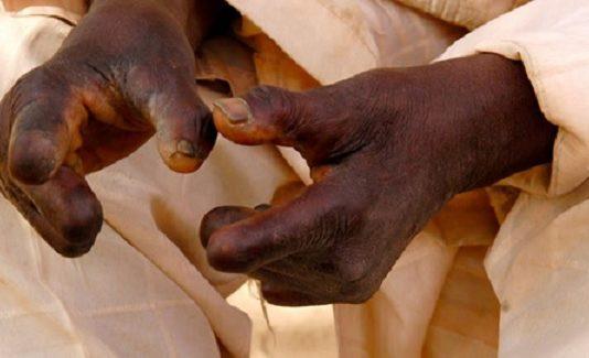 Leprosy: Delayed Detection Dangerous in Pandemic, WHO Tells Govts