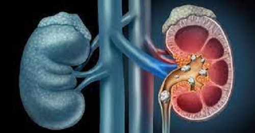 World Kidney Day: Towards a National Policy on Kidney Care