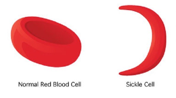 Early Diagnosis, Key to Tackling Sickle Cell Disorder Complications — NGOs