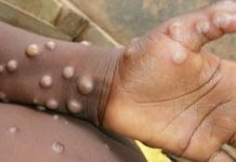 Monkeypox: Avoid Contacts with Monkeys, Squirrels & Rodents, NCDC Warns