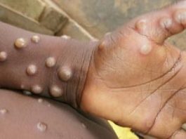 Monkeypox: Avoid Contacts with Monkeys, Squirrels & Rodents, NCDC Warns