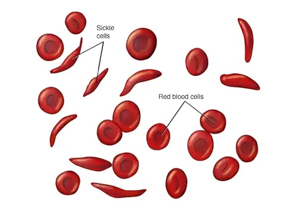 How I Survived Sickle Cell Anaemia – Consultant Haematologist 