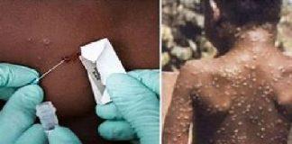 Katsina Records First Monkeypox Case, Awaiting 15 results, Says Commissioner