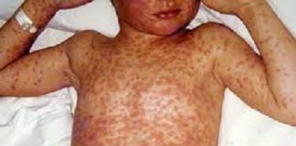 Kogi Govt Dismisses Report on Measles Outbreak