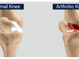 Study Affirms Over 20m People Living With Arthritis