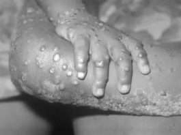 WHO to name virus 'mpox' instead of Monkey pox to avoid stigma