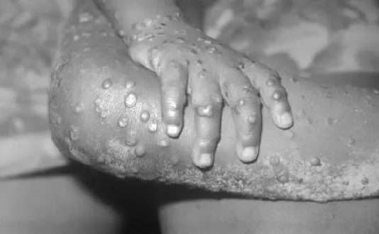 WHO to name virus 'mpox' instead of Monkey pox to avoid stigma